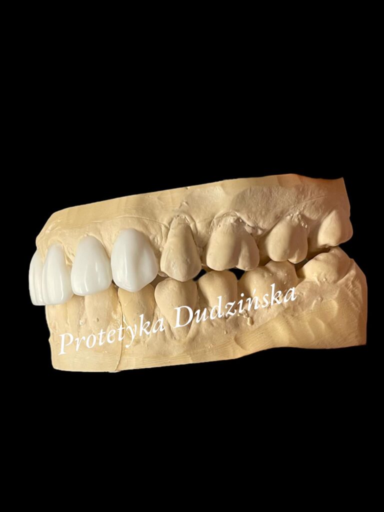 agnieszka dudzinska protetyk stomatologiczny waxup olsztyn 02