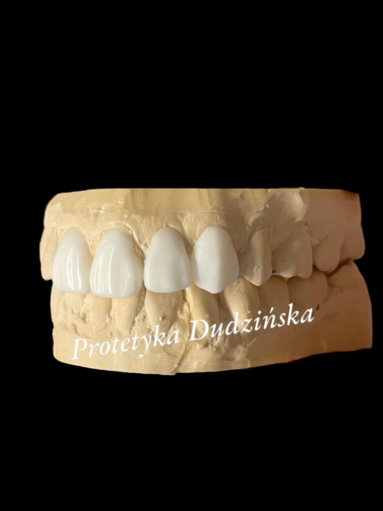 agnieszka dudzinska protetyk stomatologiczny waxup olsztyn 03