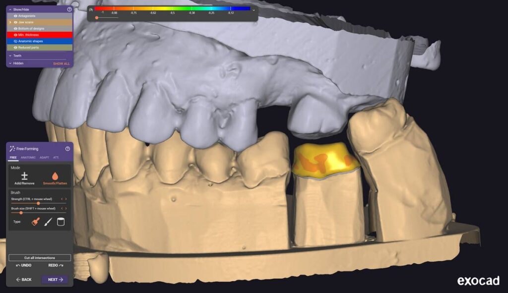 agnieszka dudzinska protetyk stomatologiczny przypadek2 olsztyn 01