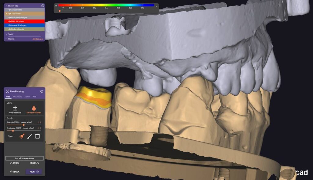 agnieszka dudzinska protetyk stomatologiczny przypadek2 olsztyn 02